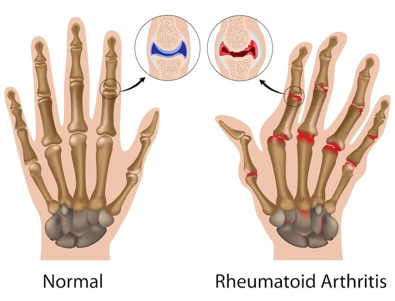 Artrite reumatoide