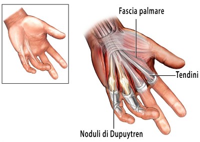 Morbo di Dupuytren