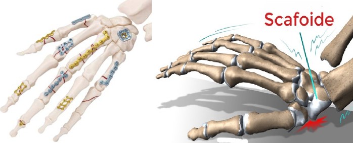 Fratture della mano e del polso