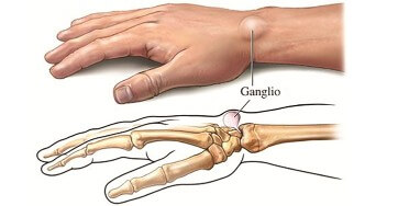 Gangli Artrogeni (Cisti Articolari)