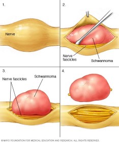 Tumori (Neurinomi, Schwannomi, Tumori Giganto-cellulari)