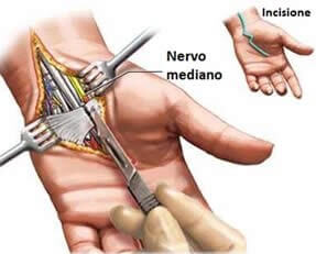 Sindromi Canalicolari - Compressioni (Sindrome Tunnel Carpale, Sindrome Canale cubitale, Sintrome Canale di Gujon)